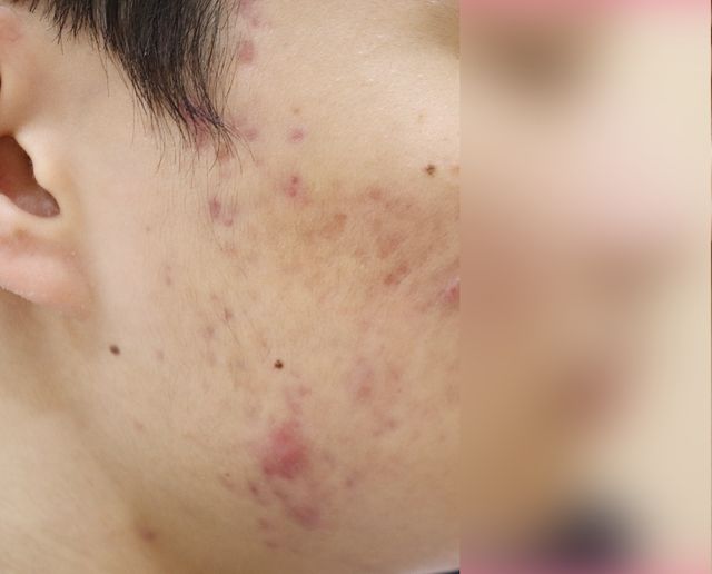 안산 습진 치료 전 · 23세 남성