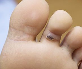 9세 여성 · 3개월 경과 · 치료 전