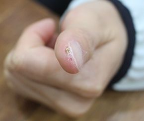 30세 여 · 5개월 경과 · 치료 전