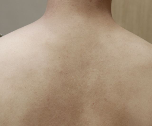 안산 아토피 치료 후 · 22세 남성 · 치료 기간 4개월