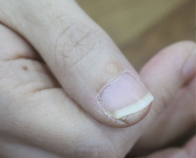 44세 여성 · 8개월 경과 · 치료 전