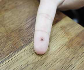 7세 여성 · 6개월 경과 · 치료 전