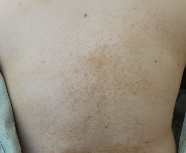 안산 습진 치료 후 · 33세 남성 · 치료 기간 9개월