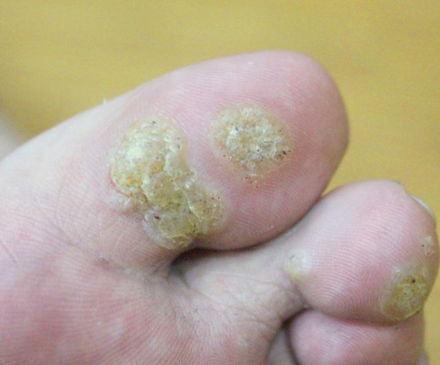 안산 사마귀 치료 전 · 36세 남성