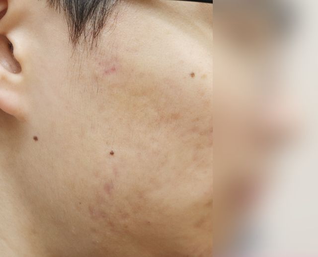 안산 습진 치료 후 · 23세 남성 · 치료 기간 5개월