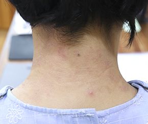 안산 아토피 치료 후 · 20세 남 · 치료 기간 9개월