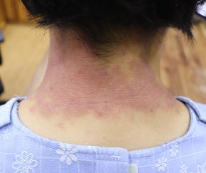 안산 아토피 치료 전 · 20세 남