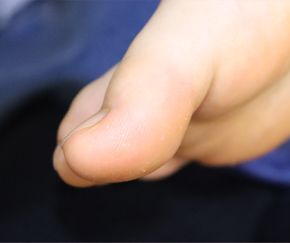 10세 여성 · 1개월 경과
