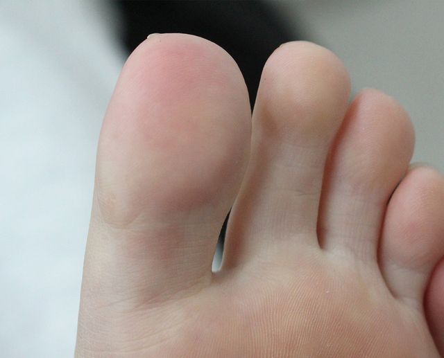 안산 사마귀 치료 후 · 28세 여성 · 치료 기간 6개월