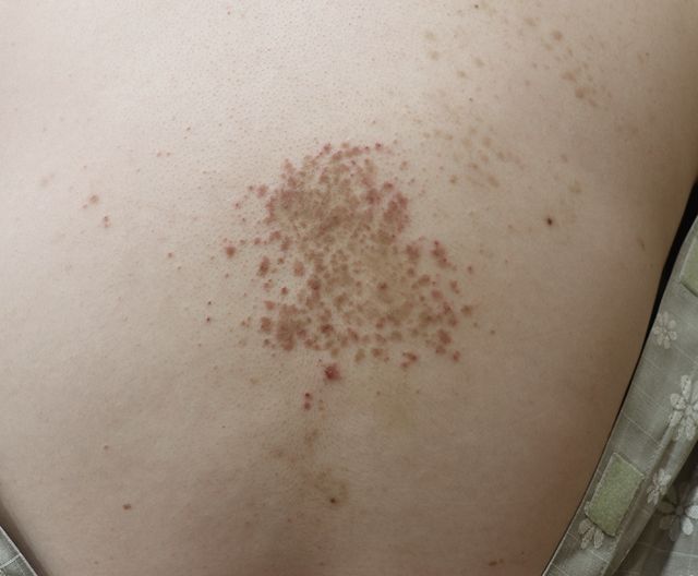 안산 습진 치료 전 · 33세 남성